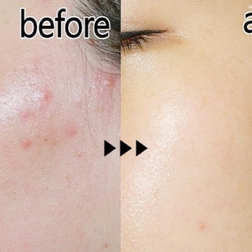 Gel Chấm Mụn SVR